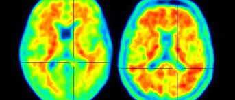 Alzheimer riskini düşürecek gen keşfedildi