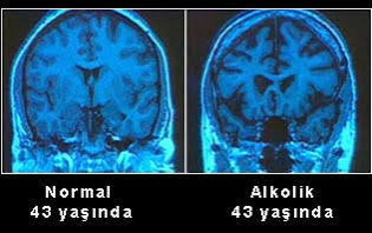 Gen&ccedil; yaşta alkol kalıcı beyin değişiklikleriyle ilişkilendiriliyor